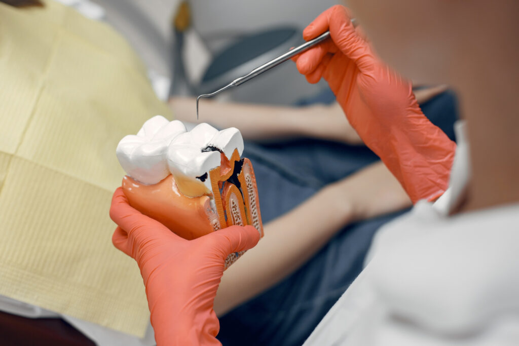 RCT (Root Canal Treatment)