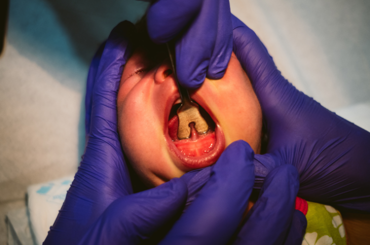 Frenectomy